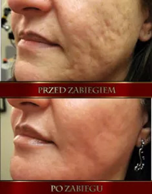 Usuwanie blizn - przed i po