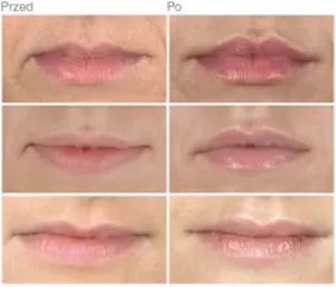 Powiększanie ust kwasem hialuronowym