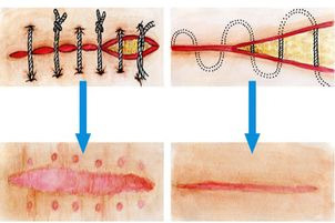 Schemat chirurgicznego usuwania blizny
