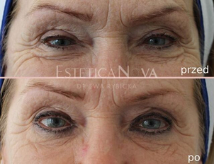 Radiofrekwnecja - przed i po