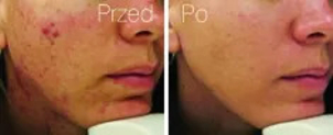 Leczenie trądziku