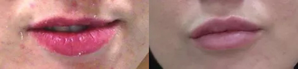 Powiększanie ust własnym tłuszczem - przed i po