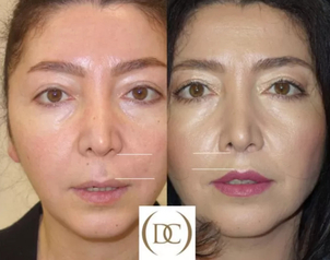 Bullhorn lip lift - korekcja ust