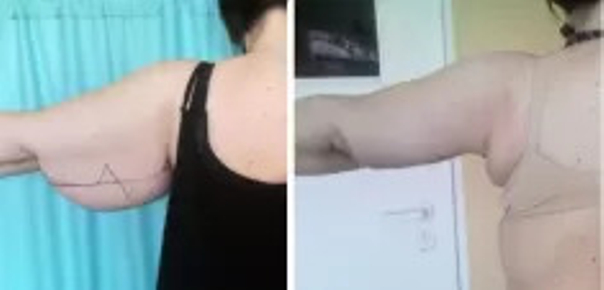 Plastyka ramion: przed i po