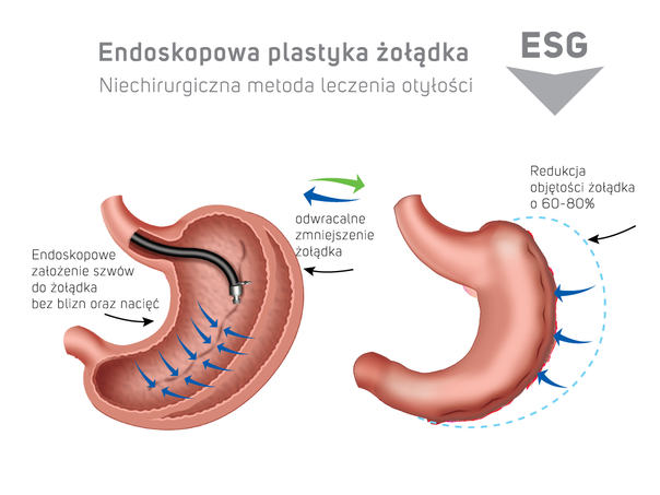 Endoskopowe zmniejszenie żołądka
