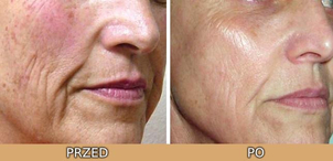 Usuwanie rumienia laserem - efekty