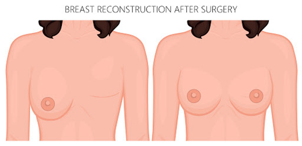 Rekonstrukcja piersi