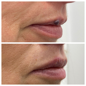 Laserowe usuwanie zmian skórnych – efekty