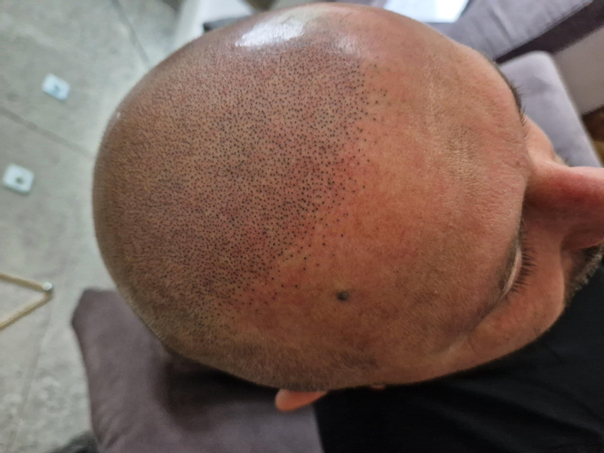 Zabieg mikropigmentacji skóry głowy