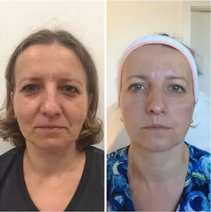 Wolumetria przed i po