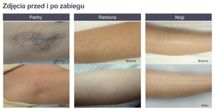 Efekty depilacji laserowej