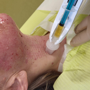 Zabieg PRP z użyciem pistoletu