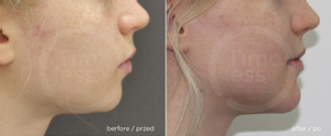 Genioplastyka – przed i po