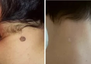 Usuwanie znamion laserem