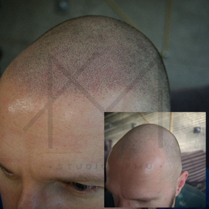 Mikropigmentacja skóry głowy: przed i po (AMStudioPMU)