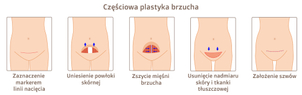 Schemat miniabdominoplastyki
