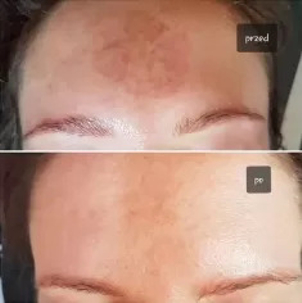 Laserowe usuwanie przebarwień: przed i po