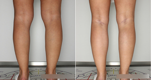 Laserowe leczenie żylaków: przed i po