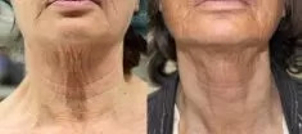 Nieinwazyjny lifting przed i po