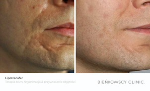 Przeszczep tłuszczu - przed i po