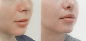 Efekty lip lift dr n. med. Rafał Pabiańczyk