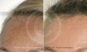 Peeling - przed i po