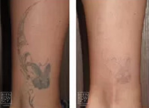 Laserowe usuwanie tatuaży: efekty 