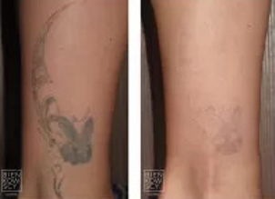 Laserowe usuwanie tatuaży: efekty