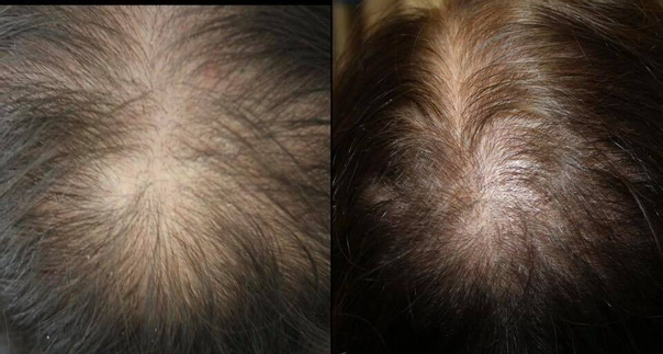 Mezoterapia skóry głowy Regenera Activa