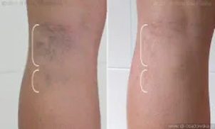 Skleroterapia pajączków - efekty