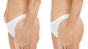 Powiększanie pośladków tłuszczem - przed i po