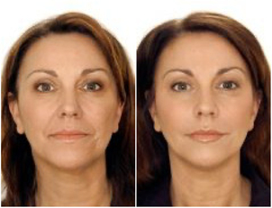 Efekty mezoterapii (dr n. med. Barbara Rygoł)