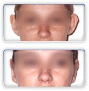 Korekcja odstających uszu