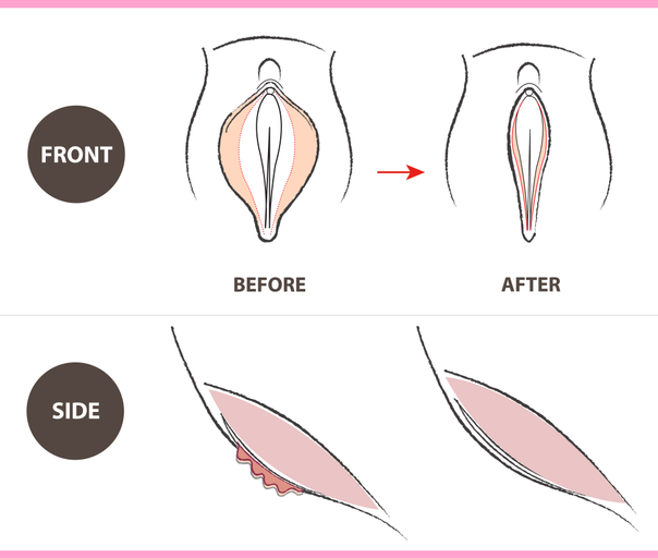 Budowa warg sromowych przed i po labioplastyce
