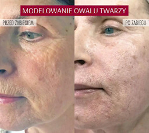 Wolumetria przed i po