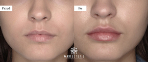 Powiększanie ust tłuszczem: przed i po