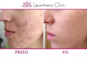 Leczenie trądziku - efekty