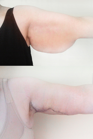 Brachioplastyka - efekty