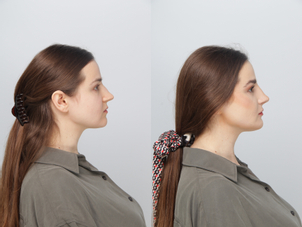 Korekta nosa kwasem hialuronowym