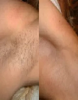 Efekty zabiegu depilacji IPL