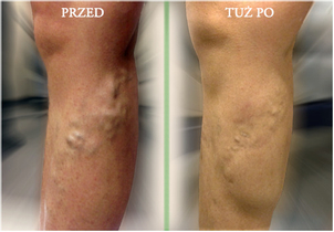 Klejenie żylaków: przed i po