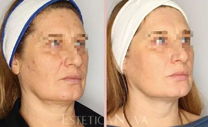 Lifting HIFU - efekty