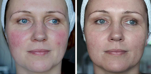 Leczenie rumienia przed i po