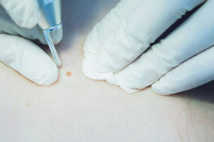 Usuwanie zmian skórnych