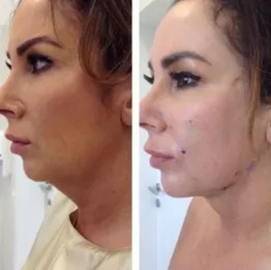 Lifting podbródka - efekty