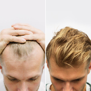 Przeszczep włosów efekty