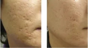 Laseroterapia blizn potrądzikowych - przed i po