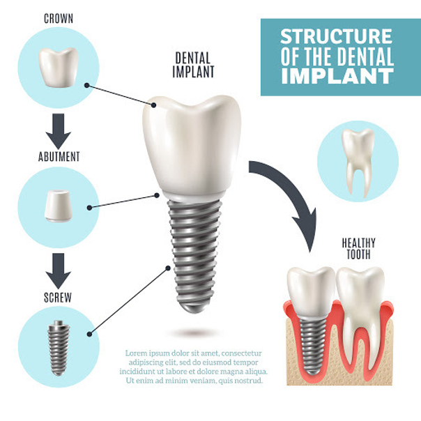 Struktura implantu