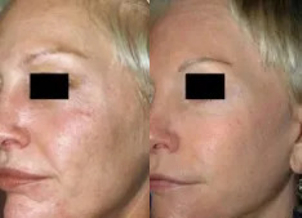 Laseroterapia - przed i po