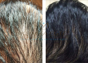 Mezoterapia skóry głowy: efekty